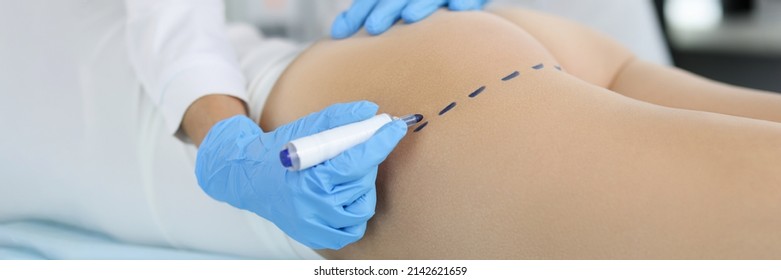 Doctor Making Preoperative Marking On Patient Buttocks Closeup