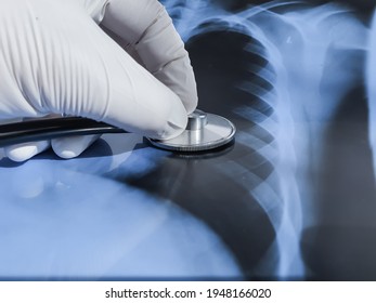 Doctor In Medical Protective Gloves Exams Patient Xray Rtg Lungs Concept. Diagnosis Of Coronavirus Covid Pneumonia With Stethoscope On Lungs Radiography. Concept Image For Auscultation Of Lung Disease