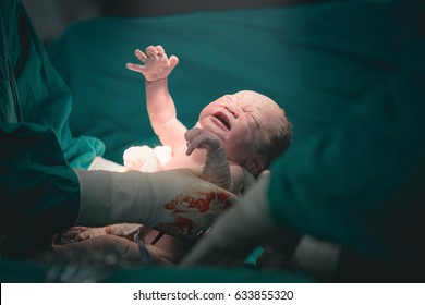 Doctor And Nurse Are Pulling A New Born Baby From Mom's Abdomen - Concept Genesis