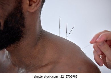 doctor performing acupuncture therapy for black male client. young man undergoing acupuncture treatment with a line of fine needles inserted into the body skin in clinic hospital, close-up - Powered by Shutterstock