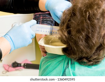 Doctor Performing Medical Treatment, Removing Patient Earwax With Pushing Water In Ear With Big Medical Syringe. Hearing Loss Concept.