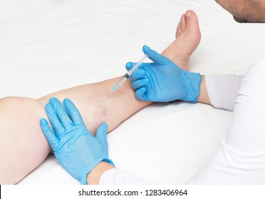 Doctor Performs Sclerotherapy For Varicose Veins On The Legs, Varicose Vein Treatment, Copy Space, Injection