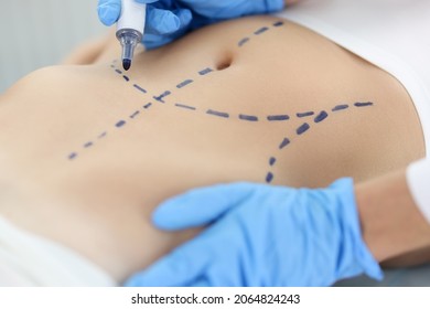 Doctor Plastic Surgeon Drawing Preoperative Markings On Skin Of Patient Abdomen Closeup