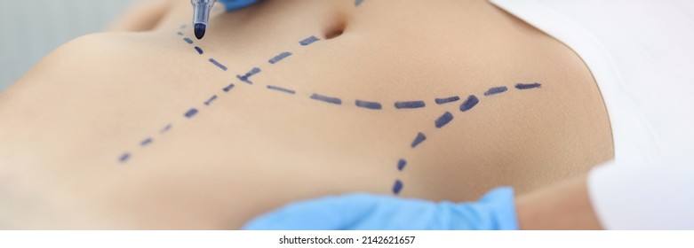 Doctor Plastic Surgeon Drawing Preoperative Markings On Skin Of Patient Abdomen Closeup