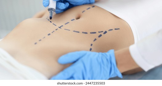 Doctor plastic surgeon drawing preoperative markings on skin of patient abdomen closeup. Plastic surgery and aesthetic medicine liposuction concept - Powered by Shutterstock