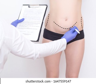 Doctor Plastic Surgeon Marks With A Felt-tip Pen A Marker For A Surgical Operation To Remove Fat On The Abdomen Of A Girl. The Concept Of The Modern Procedure In Plastic Surgery Abdominoplasty