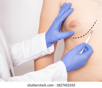 Doctor Plastic Surgeon With Scalpel Near Male Patient's Chest. Male Breast And Nipple Reduction Concept, Close-up