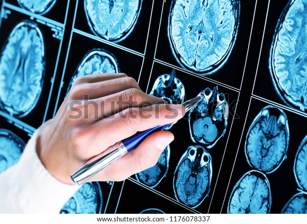 Doctor pointing with pen\
to the brain
