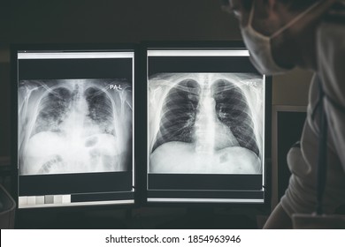 Doctor radiologist looking at difference between healthy and damaged lungs on x-ray image of patient with coronavirus Covid-19.