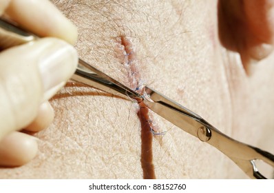 A doctor removes blue suture stitches from a healing wide local excision on the neck for basal cell cancer using a suture removal kit.