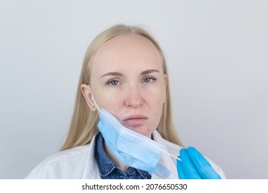 Doctor Removes The Protective Mask And Shows Irritation On Face Skin. Antiviral Measures. Means Of Protection Against Covid 19. Long Wearing Of A Mask. Acne On Face And Chafing. Dry Lips And Red Dots