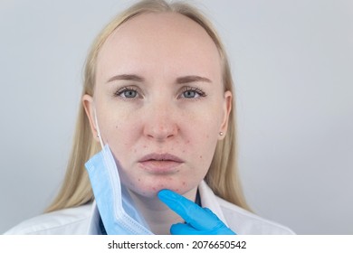 Doctor Removes The Protective Mask And Shows Irritation On Face Skin. Antiviral Measures. Means Of Protection Against Covid 19. Long Wearing Of A Mask. Acne On Face And Chafing. Dry Lips And Red Dots