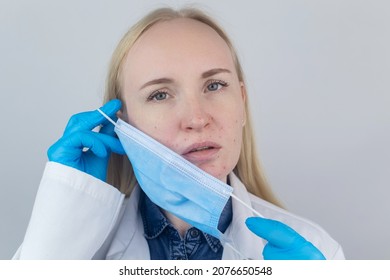 Doctor Removes The Protective Mask And Shows Irritation On Face Skin. Antiviral Measures. Means Of Protection Against Covid 19. Long Wearing Of A Mask. Acne On Face And Chafing. Dry Lips And Red Dots