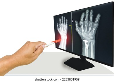 The doctor reported the x-ray results of the wrist and hand of the fractured patient and performed bone fixation surgery. Medical healthcare and education concept. - Shutterstock ID 2233831959