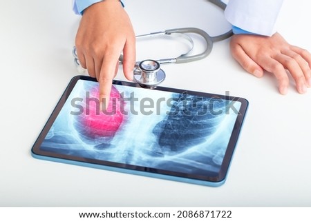 Doctor or scientist points to the results of lung check up from x-ray scan chest on tablet screen to patient. Lung Cancer, Pneumonia, lung infection.