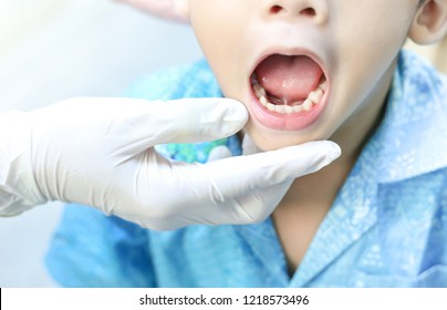 doctor screening and diagnosis mouth of tongue-tie patient , dental health problem no.4