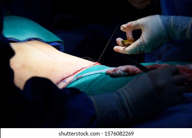 Doctor sewing up stomach skin after a tummy tuck surgery