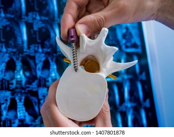 Doctor Show Polyaxial Screw On The Spine Model. Spine Fixation Systems. Spinal Surgery