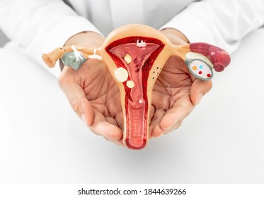 Doctor showing an anatomical model of the uterus and ovaries with pathologies, close-up. Gynecological diseases and treatments