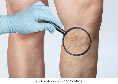 doctor shows the dilation of small blood vessels of the skin on the leg. Medical inspection and treatment of Telangiectasia, cosmetology
