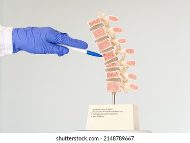 The doctor shows a model of the human spine, which shows various defects in the vertebrae. Inscriptions on the model: 1-Compression fracture, 2-Normal vertebral, 3-Osteoporotic bone, 4-Wedge fracture. - Powered by Shutterstock