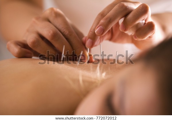 The doctor sticks needles into the girl\'s\
body on the acupuncture