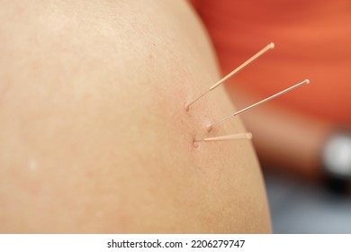 doctor sticks needles into the human body on the acupuncture. Traditional Chinese Medicine. acupuncture treatment. - Shutterstock ID 2206279747