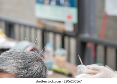 doctor sticks needles into the man head on the acupuncture. Traditional Chinese Medicine. acupuncture treatment. - Shutterstock ID 2206280167