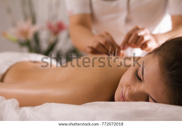 The doctor sticks needles into the woman\'s body\
on the acupuncture - close\
up