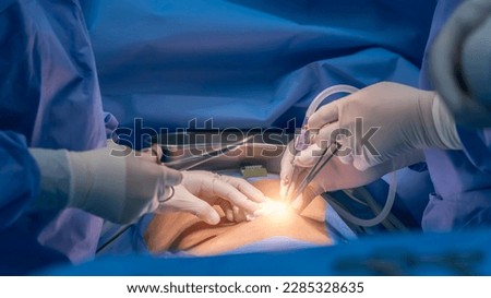 Doctor or surgeon in blue gown puts air in abdominal cavity to make pneumoperitoneum in minimal invasive laparoscopic surgery.Laparoscopy technology use for diagnosis or cholecystectomy with light.