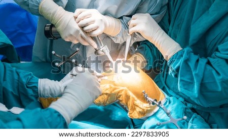 Doctor or surgeon in blue gown used robotic navigator total knee joint arthroplasty surgical instrument inside operating room.Medical technology in orthopedic surgery.Hand of people with a saw.