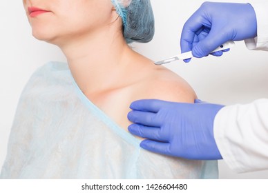 Doctor Surgeon Holds A Scalpel Against The Background Of The Shoulder Of The Girl Concept Of Surgery On The Shoulder Joint And The Replacement Of An Artificial Joint, Arthroplasty