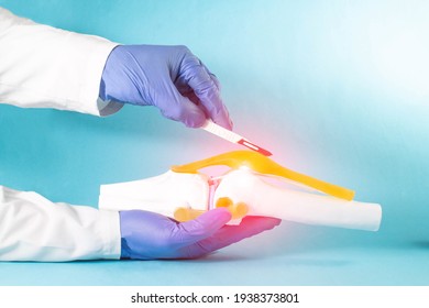 Doctor Surgeon Holds A Scalpel Near The Knee Joint Mockup On A Blue Background. The Concept Of Joint Replacement Surgery, Endoprosthetics, Arthroscopy. Copy Space For Text