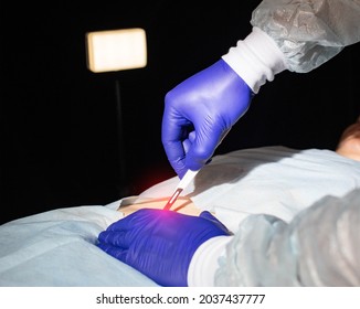 Doctor Surgeon With A Scalpel In His Hand Before Bowel Surgery In A Patient, Close-up. Small Intestine Part Removal Concept And Bowel Disease Treatment