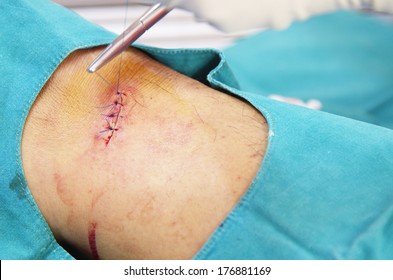 Doctor suturing cut wound three stitches.