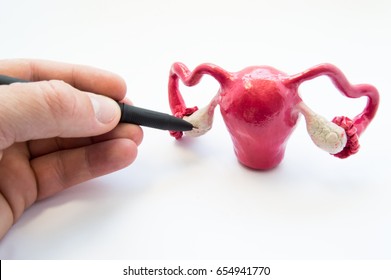 Doctor or teacher points of ballpoint pen on ovaries on anatomical model of internal female sex organs. Ovaries organ where eggs are produced, male and female hormones, as well as different diseases