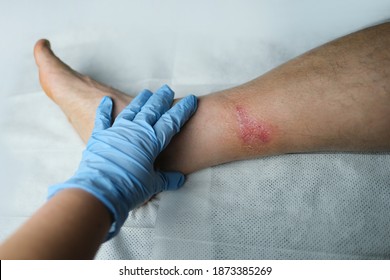 Doctor Treats A Large Healing Wound From A Severe Burn On The Leg Of An Adult Male Patient, Redness, Scarring Of The Skin, The Concept Of Medical Care, Human Tissue Regeneration