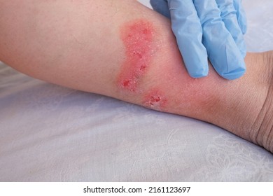 Doctor Treats Large Healing Wound On Stock Photo 2161123697 | Shutterstock