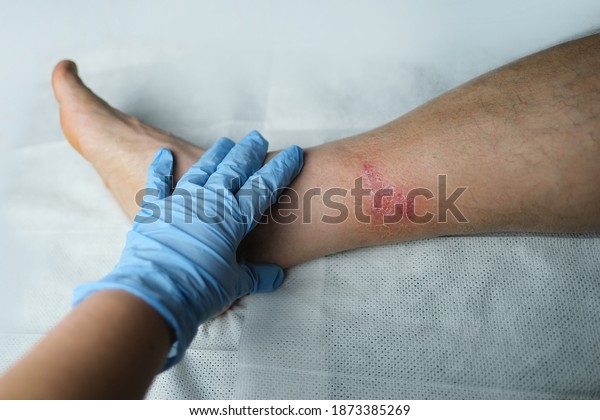 doctor treats a\
large healing wound from a severe burn on the leg of an adult male\
patient, redness, scarring of the skin, the concept of medical\
care, human tissue\
regeneration