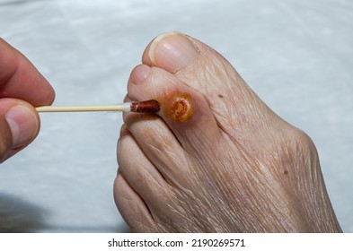 The Doctor Treats A Purulent Wound On The Leg Of An Elderly Patient With A Healing Ointment	
