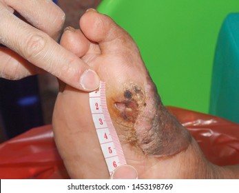 Doctor Use Measurement Tape To Measuring Size Of Wound At Foot Of Diabetic Patient. Diabetic Wound Are Cause Of Amputation Toe Or Legs.