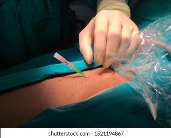 Doctor Use Puncture Needle To Puncture Femoral Artery At Groin For Prepare Peripheral Vascular Angiograhy.