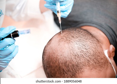 Doctor uses a thin needle to inject Platelet-Rich Plasma into the scalp. 