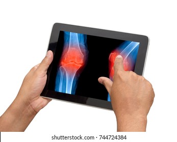 Doctor Using Tablet To Check X Ray Image Of Osteoarthritis And Inflammation Knee In Medical Application Program.