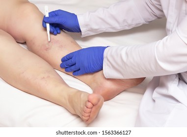 Doctor vascular surgeon holds a scalpel near the legs of a woman with a disease of varicose veins of the lower extremities. The concept of treating varicose veins with surgery - Shutterstock ID 1563366127