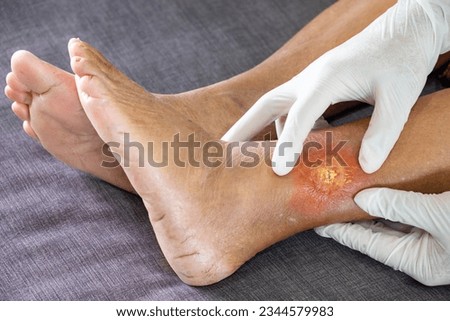 doctor wearing a white hygienic glove and holding an elderly woman's leg to check for gangrene due to diabetes. concept of healthcare and occupational health