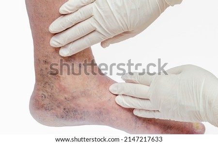 Doctor in white gloves holding man's foot and pointing to varicose veins, deep vein thrombosis, venous injuries on foot. Healthy varicose ulcer. Isolated on white background.