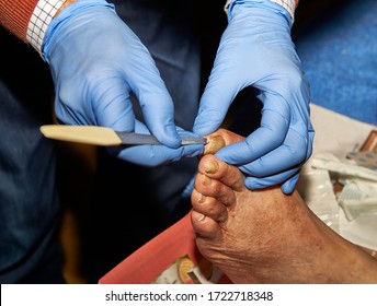 doctor wiping the big toe of an elderly diabetic with the tip of a file