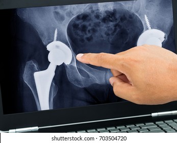 Doctor's Hand Pointing Xray Photos Of Total Hip Replacement In Medical Application On Black Laptop Computer