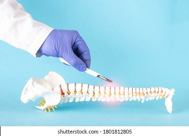 Doctor's Hand With A Scalpel Near The Mock Up Of The Human Spine On A Blue Background. Spine Surgery Concept, Vertebroplasty, Copy Space For Text, Minimally Invasive Surgery